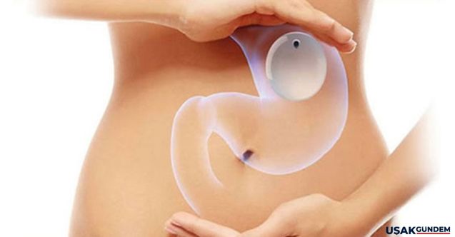 Zayıflamak isteyenler buraya! Mide balonu tedavisinin detayları paylaşıldı