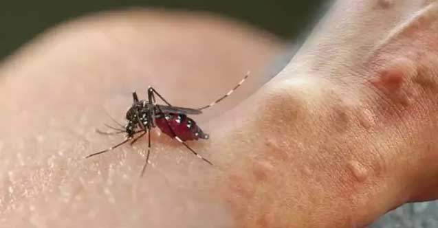 Sivrisinek kaşıntısı anında geçiyor! Kaşıntı giderici doğal formülü doktor verdi
