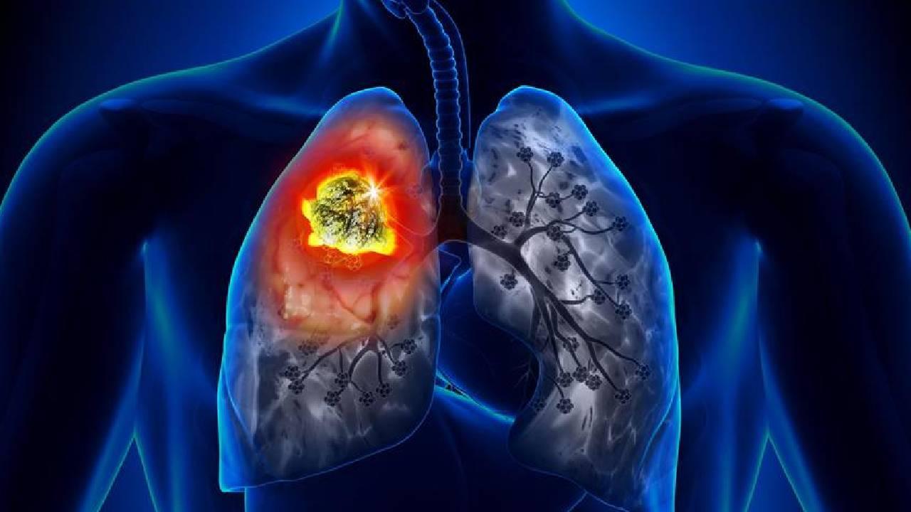 Bu belirtiler varsa akciğer kanseri olabilirsiniz!