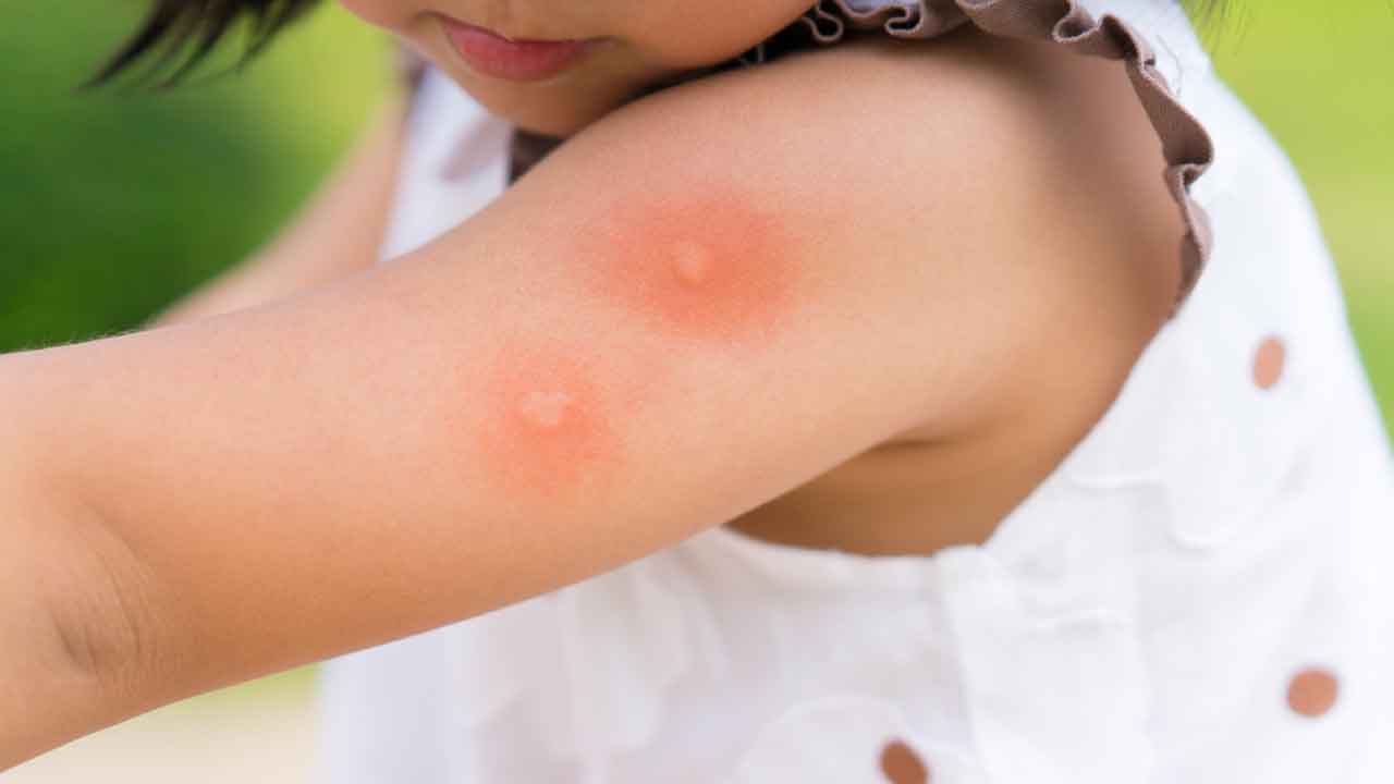 Alerji doktoru sivrisinek ısırığına ne iyi gelir açıkladı! Evdeki malzemelerle kesin çözüm