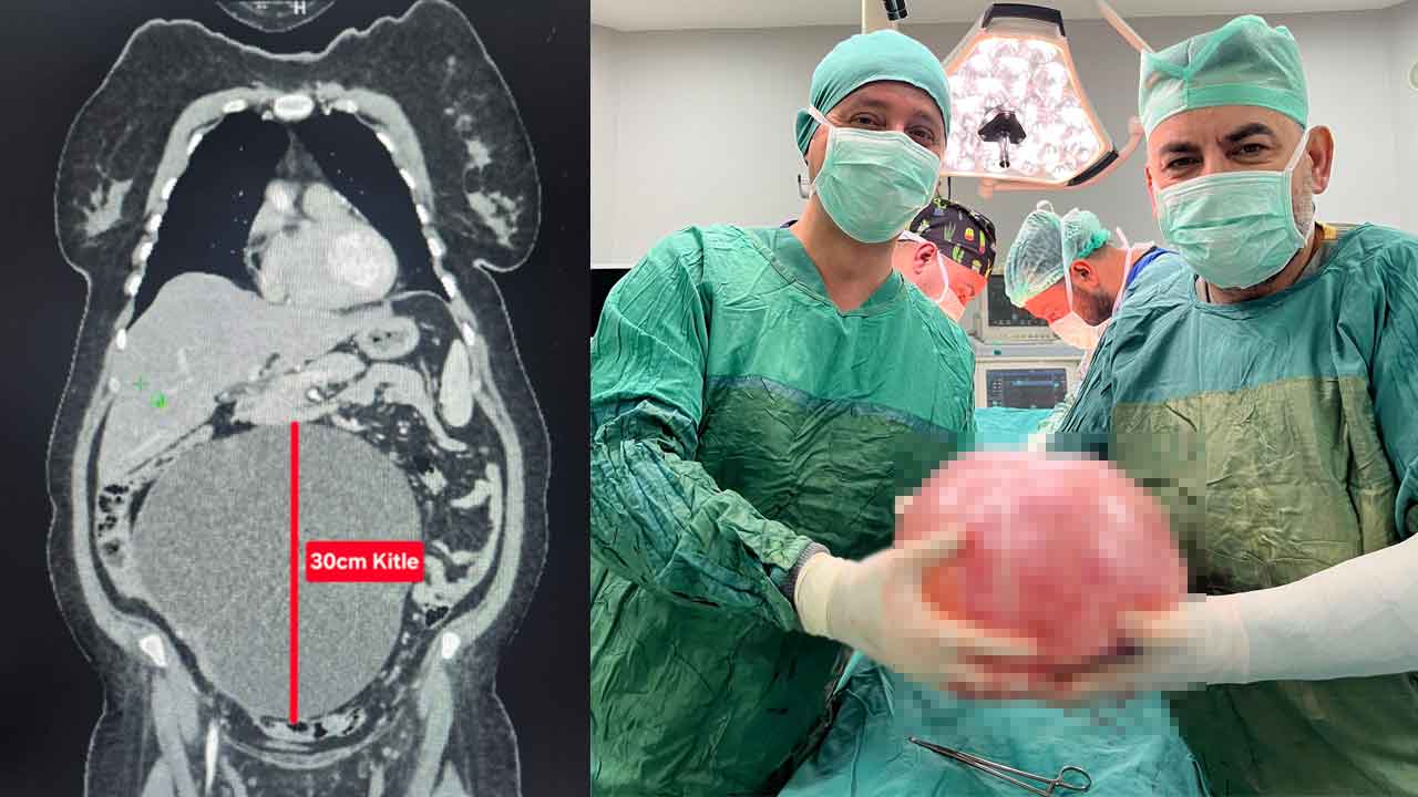 Uşak’ta 57 yaşındaki kadının karnından 14,5 kilo kitle alındı