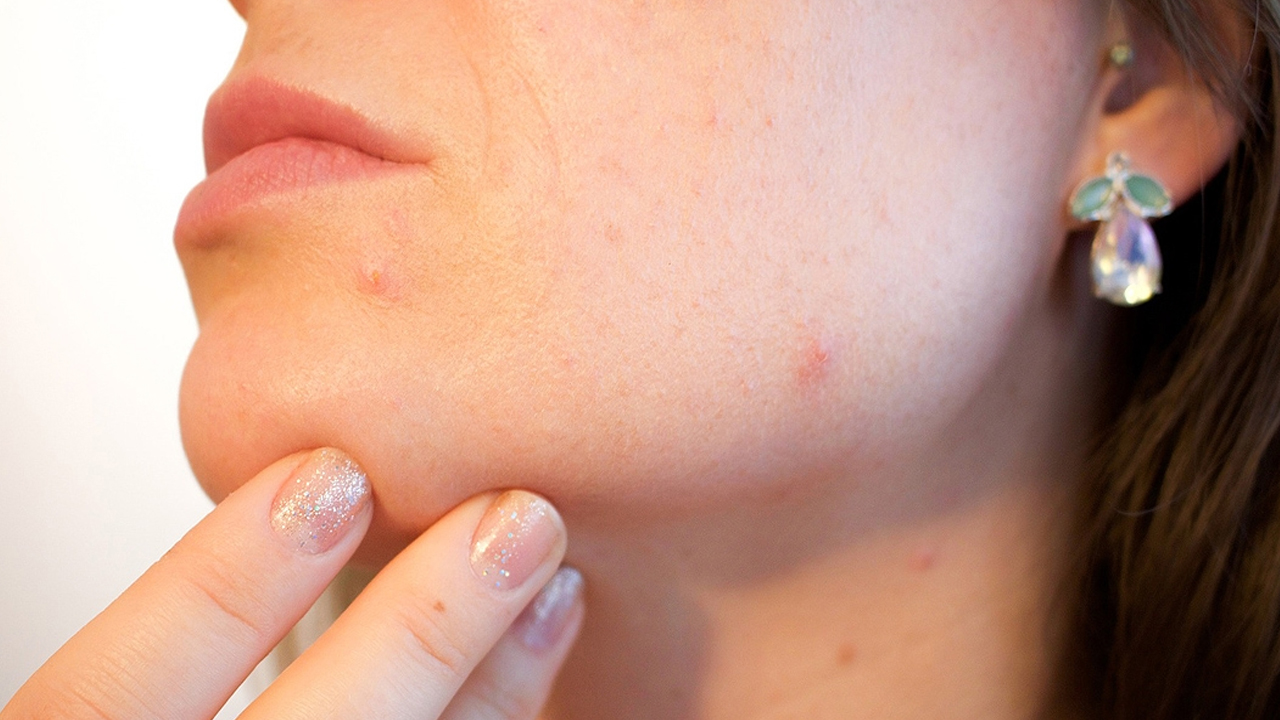 Dermatologlar Açıkladı Sivilceyi Bir Daha Geri Getirmeyen Mucizevi Yöntem