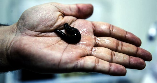 Sülük Tedavisi Nasıl Yapılır? Sülük Tedavisinin Faydaları Nelerdir?