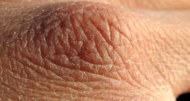 Balık Pulu Hastalığı Nedir? Belirtileri Nelerdir?