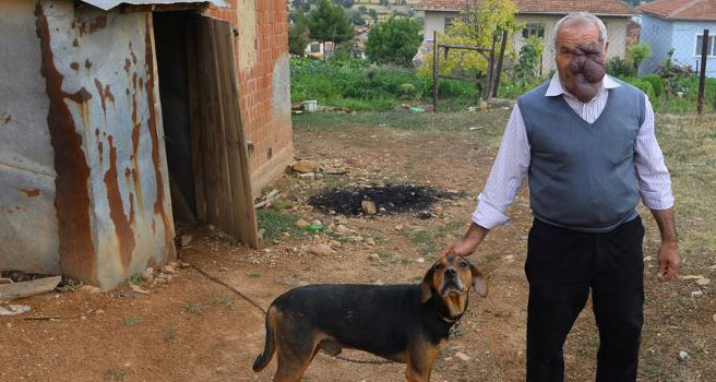 Uşaklı çiftçi yüzünü kaplayan dev tümörden kurtulmak istiyor