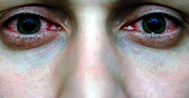 Göz kanlanması nedir? Neden olur ve nasıl geçer