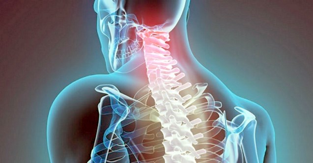 Boyun Fıtığı Belirtileri Nelerdir? İleri Derece Boyun Fıtığı Nasıl Geçer?