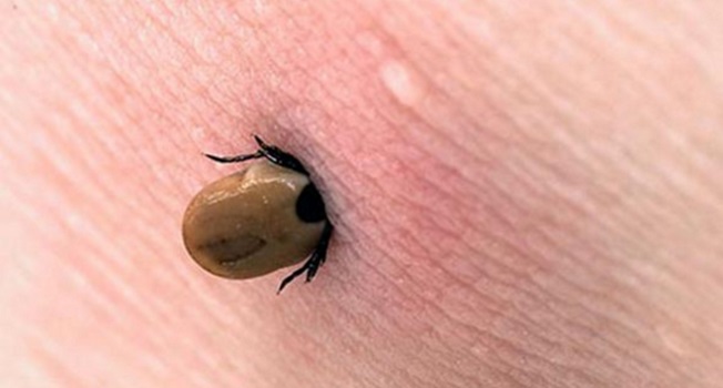 Sessiz Katil Lyme Hastalığı Nedir?