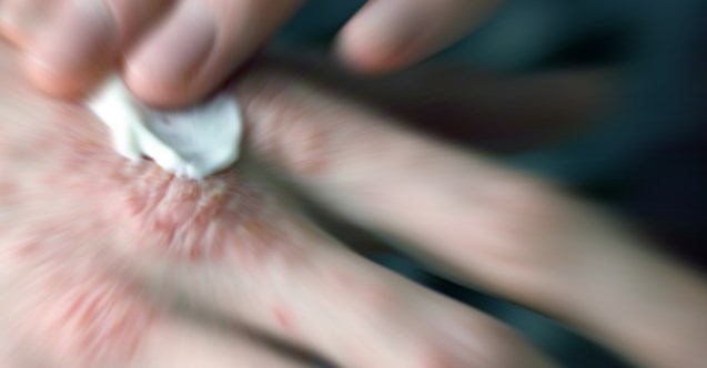 Asırlık Doğal Tarif Yeniden Gündemde,  Egzama İçin Ev Yapımı Krem