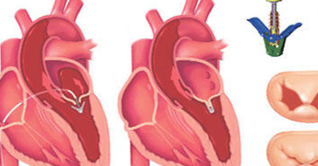 Mitral Kapak Yetmezliği Nedir?