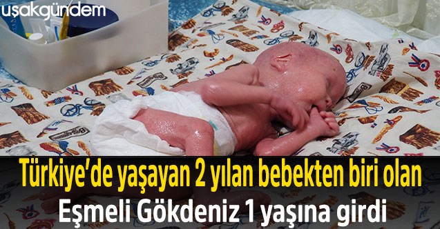 Türkiye’de yaşayan 2 yılan bebekten biri olan Eşmeli Gökdeniz 1 yaşına girdi