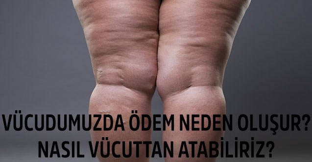 Vücudumuzda Ödem Neden Oluşur?  Nasıl Vücuttan atabiliriz?