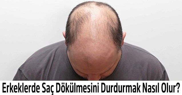 Erkeklerde Saç Dökülmesini Durdurmak Nasıl Olur?